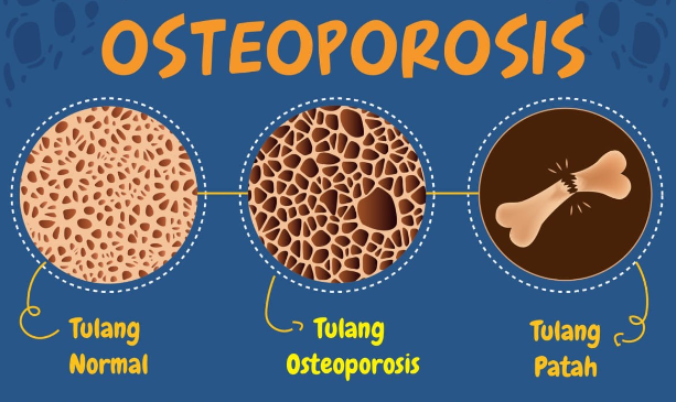 osteophorosis