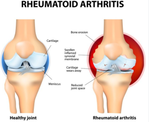 Rematik Artritis
